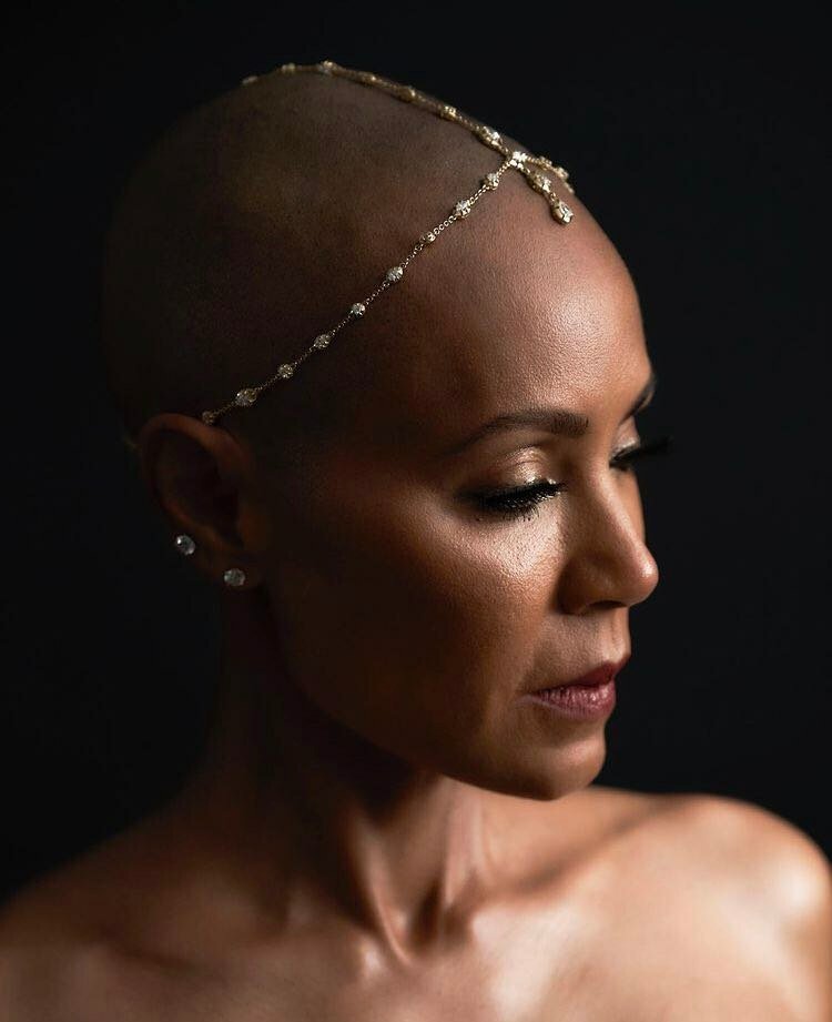 Jada Pinkett trpí alopecií.