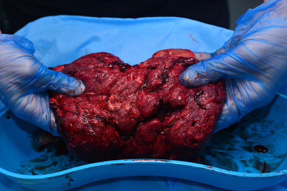 Takto vypadá placenta těsně po porodu.