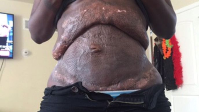 Quanna Brownová se rozhodla zveřejnit fotografie svého těla znetvořeného nepovedenou plastickou operací. 