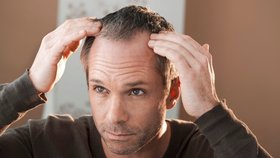 Alopecie je stále častější: Také vás trápí pleš?