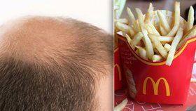 Látka z hranolek McDonald’s může být nápomocná při léčbě padání vlasů.