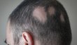 Příklad alopecia areata