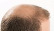 Příklad androgenní alopecie