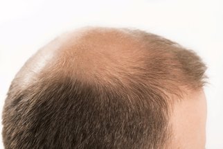 Alopecie