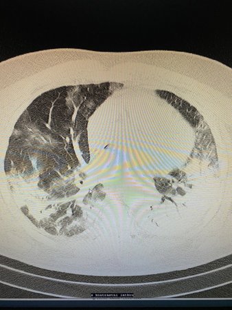 Covid a plíce: Pacient (38), bez závažných komorbidit, těžké plicní postižení. Kritický
