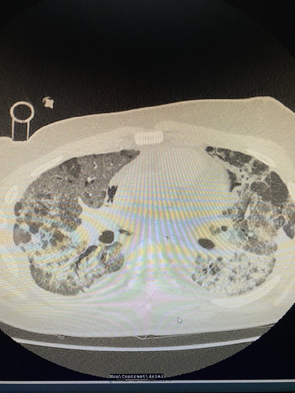 Covid a plíce: Pacient (40), dosud plně zdráv. Nyní progredující fibróza/vazivovatění plicní tkáně