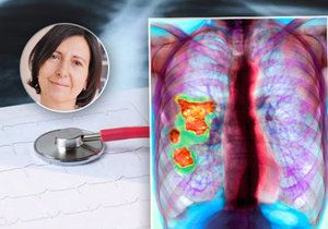 Idiopatická plicní fibróza poškozuje plicní sklípky, jizví je – bere plochu k dýchání, plíce tuhnou a člověk se nemůže nadechnout. 