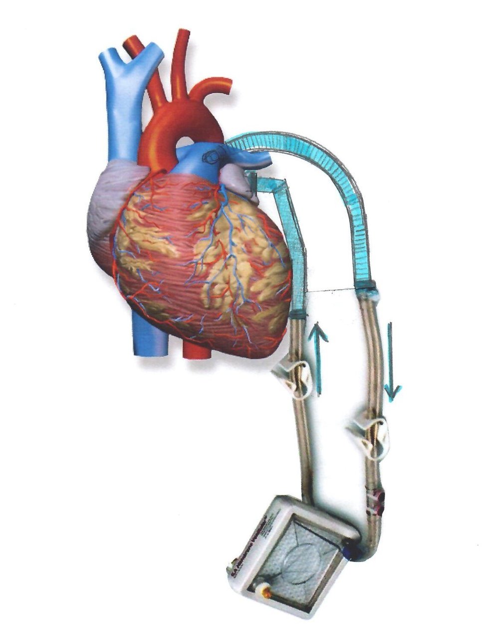 Princip operace spočívá ve vytvoření obchvatu mezi hlavní plicní tepnou, která vede krev ze srdce do plic, a levou síní, kam za normálních okolností přitéká okysličená krev z plic.