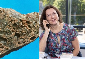 Plicních fibróz je více druhů, všechny ale mají stejný rys – postupují v čase, mají tendenci zajizvovat plicní tkáň a pacienta časem udusit. Proto je nesmírně důležité nasadit včas léčbu, která procesu jizvení brání,“ vysvětluje přednostka Pneumologické kliniky Fakultní Thomayerovy nemocnice a 1. LF UK prof. MUDr. Martina Koziar Vašáková, Ph.D.