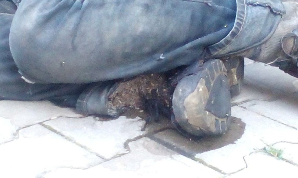 Další případ z Plzně:  Z nohy bezdomovce odpadávali červi.
