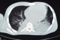 Otrava krve i zánět mozkových blan: Na pneumokokovou infekci umírá každý šestý pacient, varují lékaři