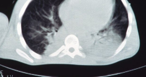 Pneumokoková meningitida