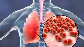 Zákeřné pneumokokové infekce ohrožují seniory: Jaká je prevence? 