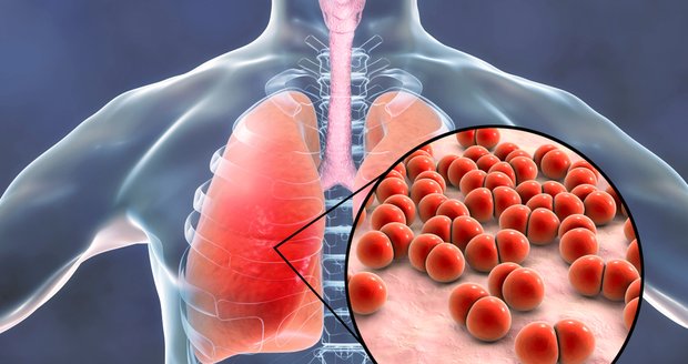 Zákeřné pneumokokové infekce ohrožují seniory: Jaká je prevence? 