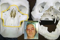 Polákovi amputovala řezačka tvář: Narychlo mu transplantovali obličej!