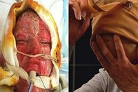 Popálená Dana si sundala masku: Jak vypadá po 30 operacích?