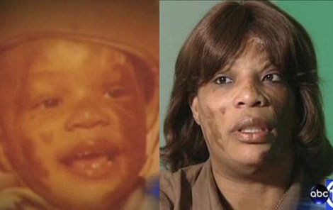 Dnes je Amy už 41 let. Prodělala 200 operací, 20 let bojovala o život.
