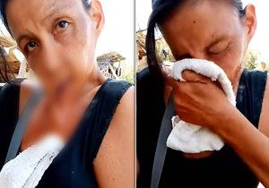 Žena utrpěla vážná zranění z popálení obličeje