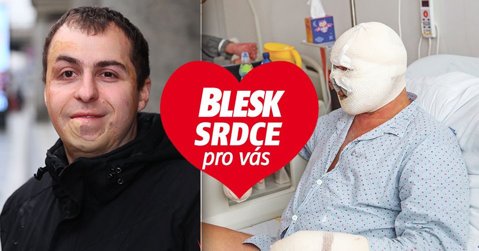Petr Ilčík (32) z Hodonína utrpěl před 27 lety závažné popáleniny. Uměl se s tím ale vyrovnat.