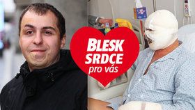 Petr Ilčík (32) z Hodonína utrpěl před 27 lety závažné popáleniny. Uměl se s tím ale vyrovnat.