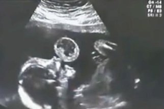 Vypadalo to jako bublina. Obraz na ultrazvuku ale ukazoval smrtelný problém! 
