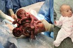 Dvojčátka - sestry se narodila o deset týdnů dřív: Poté, co je vyňali z dělohy, se objímaly!