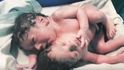 Indka porodila siamská dvojčata.