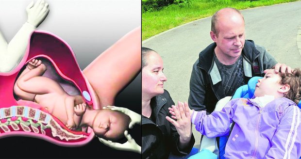 Porodník tlačil Janě při porodu loktem na břicho: Zmrzačil jim dceru, matce prorazil dělohu