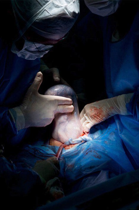 Tento snímek zachycuje porod císařským řezem.
