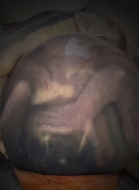 Miminko lékaři v porodnici v Buenos Aires porodili v plodovém vaku.
