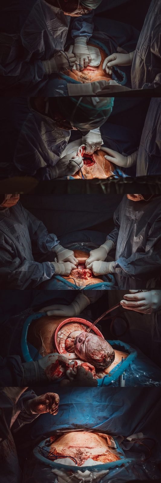 Operační porod okem Laury Brink.