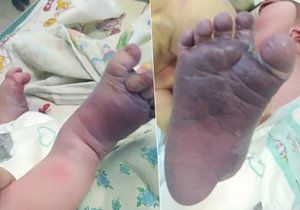 Na domácí porod si najali nekvalifikované asistentky: Dítě skončilo s polámanýma nohama.
