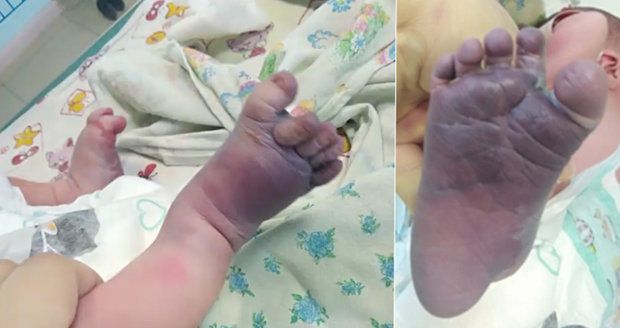 Domácí porod skončil neštěstím: Dula zlámala miminku nohy