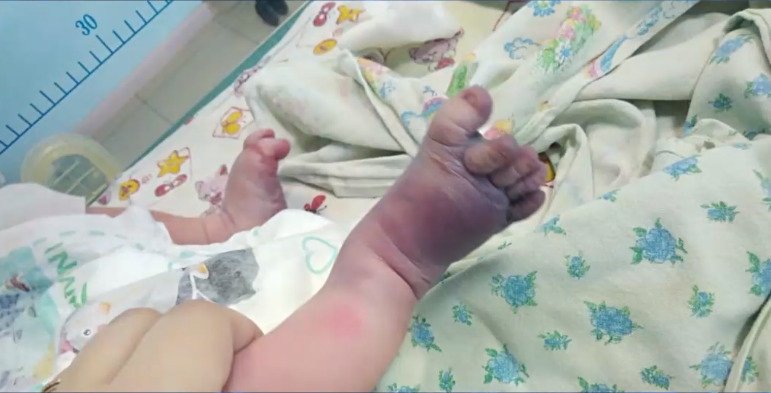 Nekvalifikované porodní asistentky zlámaly novorozenci při porodu obě nožičky.