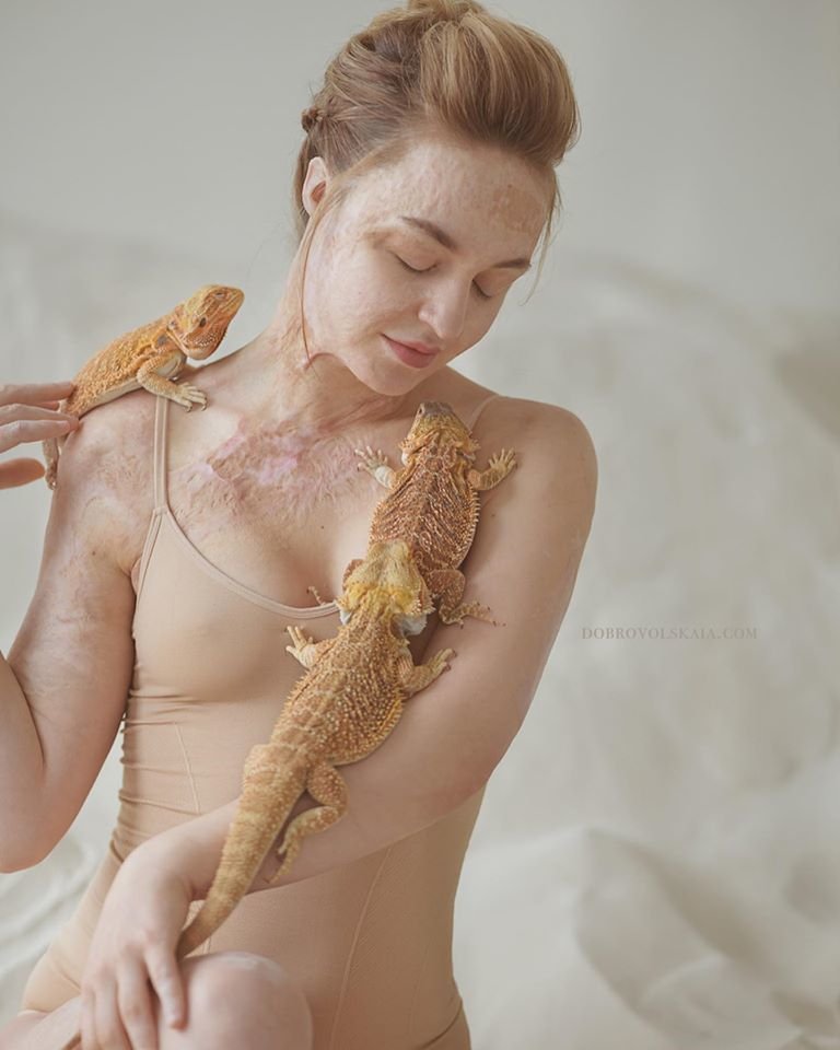 Popálená dívka s gekony.