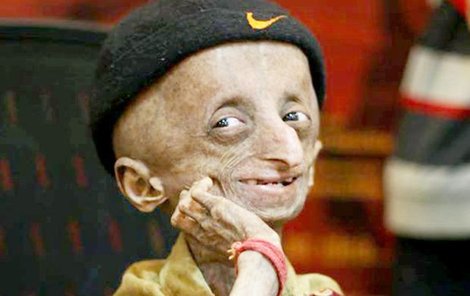 Nihal se stal jednou z tváří nadace, která se snaží získat prostředky na výzkum progerie a vyvinutí léku.