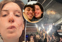 Veterinářka přežila peklo ve švýcarském baru: Plameny jí sežehly obličej!