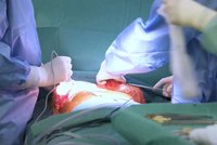 „Zázračná“ operace v Motole: Pacientovi (15) najednou transplantovali srdce i plíce!