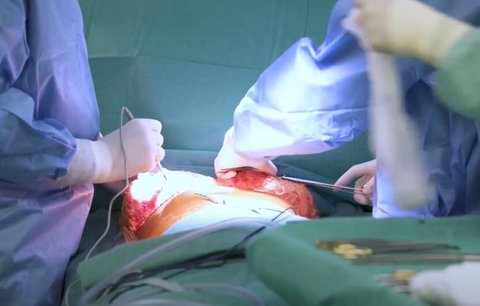 „Zázračná“ operace v Motole: Pacientovi (15) najednou transplantovali srdce i plíce!