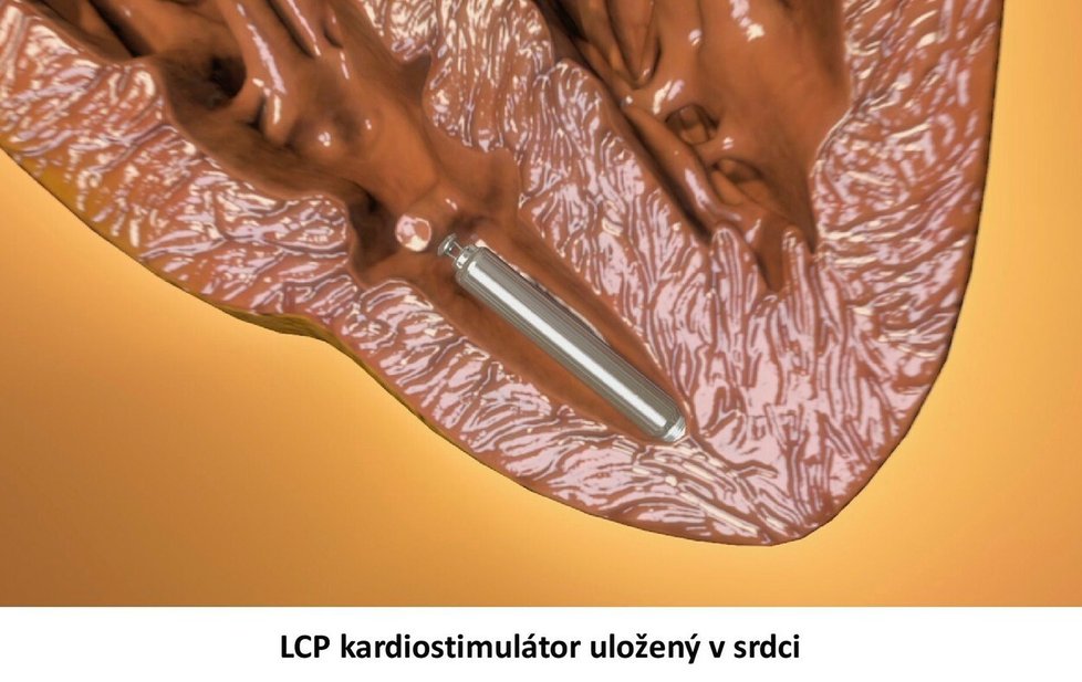 2. prosince 2012 implantovali v Nemocnici Na Homolce první bezdrátový kardiostimulátor na světě.