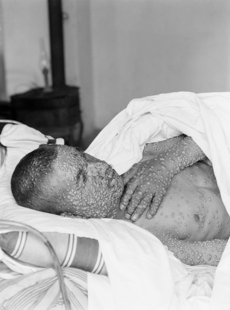 Pravé neštovice zabily jen ve 20. století až 500 milionů lidí, což je více než čtyřnásobek počtu obětí 2. světové války.