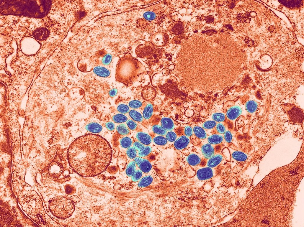 Virus neštovic (variola) způsobuje mimo jiné typickou vyrážku po celém těle.
