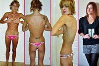 Anorektička vážila 28 kilo! Šikanovali ji kvůli velkému poprsí