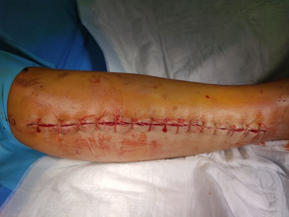 Takto vypadala Verči noha po operaci.