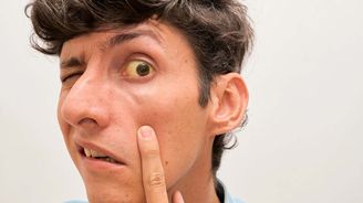 Jak poznat žloutenku typu A včas: 7 příznaků, které mohou vypadat jako viróza Jak poznat žloutenku typu A včas: 7 příznaků, které mohou vypadat jako viróza