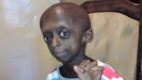 Dívka stárne nepřirozeně rychle, trpí totiž chorobou zvanou Progerie