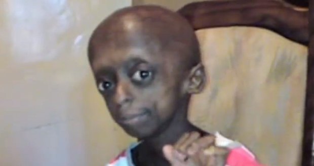 Dívka stárne nepřirozeně rychle, trpí totiž chorobou zvanou Progerie
