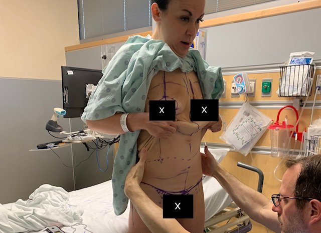 Letos v dubnu čeká mladou Američanku poslední plastická operace, která ji zbaví přebytečné kůže v oblasti paží.