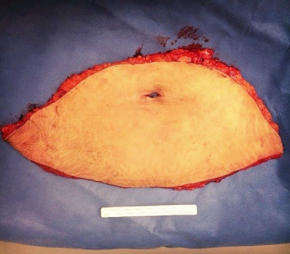 Podstoupila proto plastickou operaci břicha.
