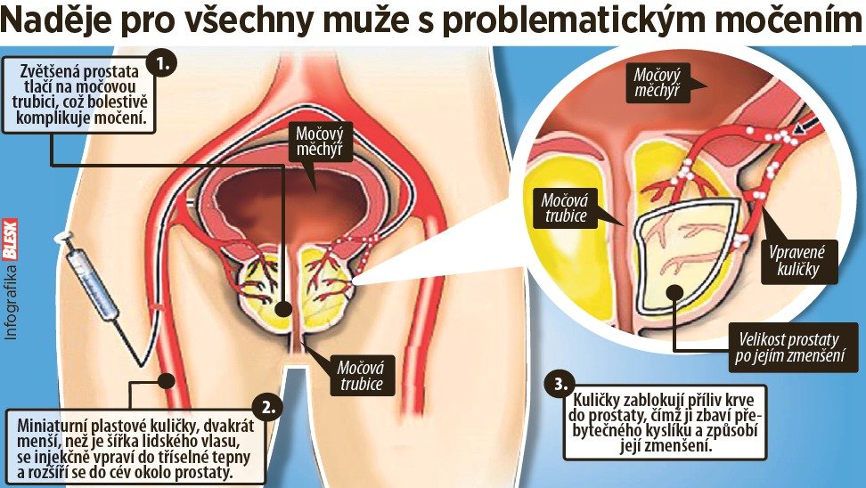 Nová metoda léčby prostaty